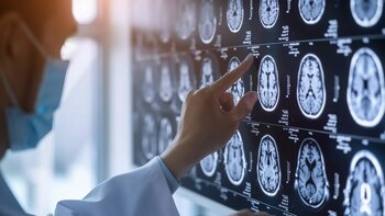 El tumor cerebral puede ser